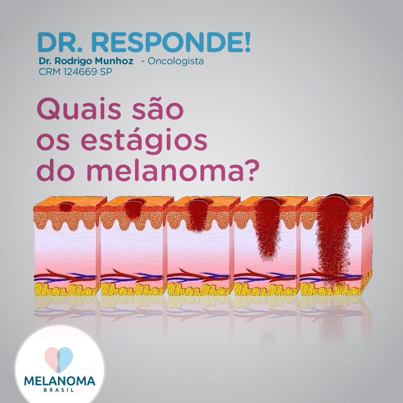 Quais são os estágios do melanoma?