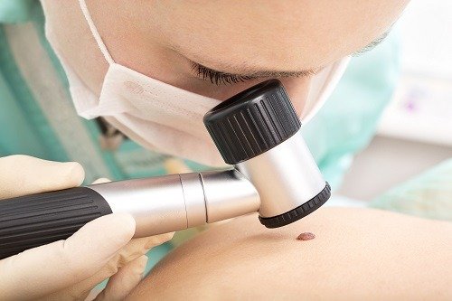 Ocorrência do melanoma avança entre as mulheres